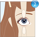 Holding eyelids apart for lens removal